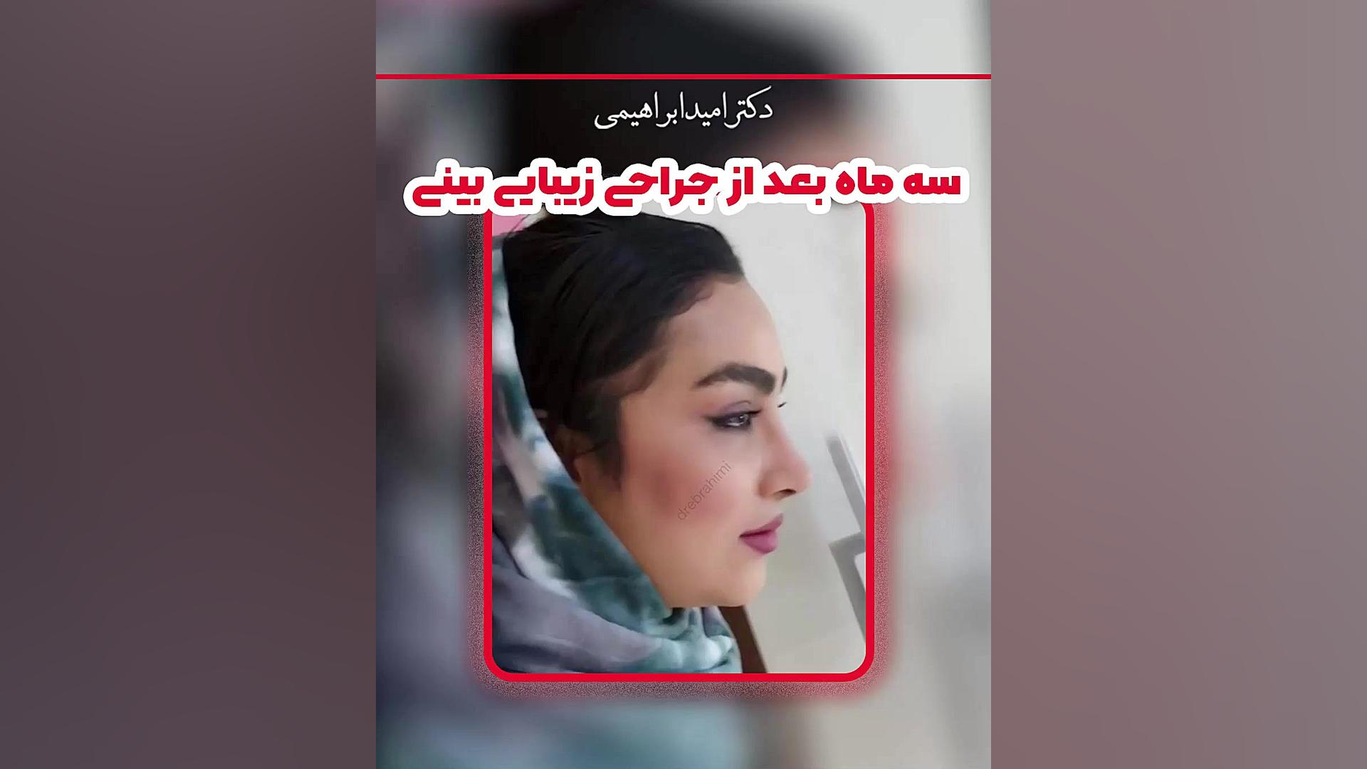 جراحی زیبایی بینی توسط دکتر امید ابراهیمی بهترین جراح بینی در تهران دکتر امید ابراهیمی