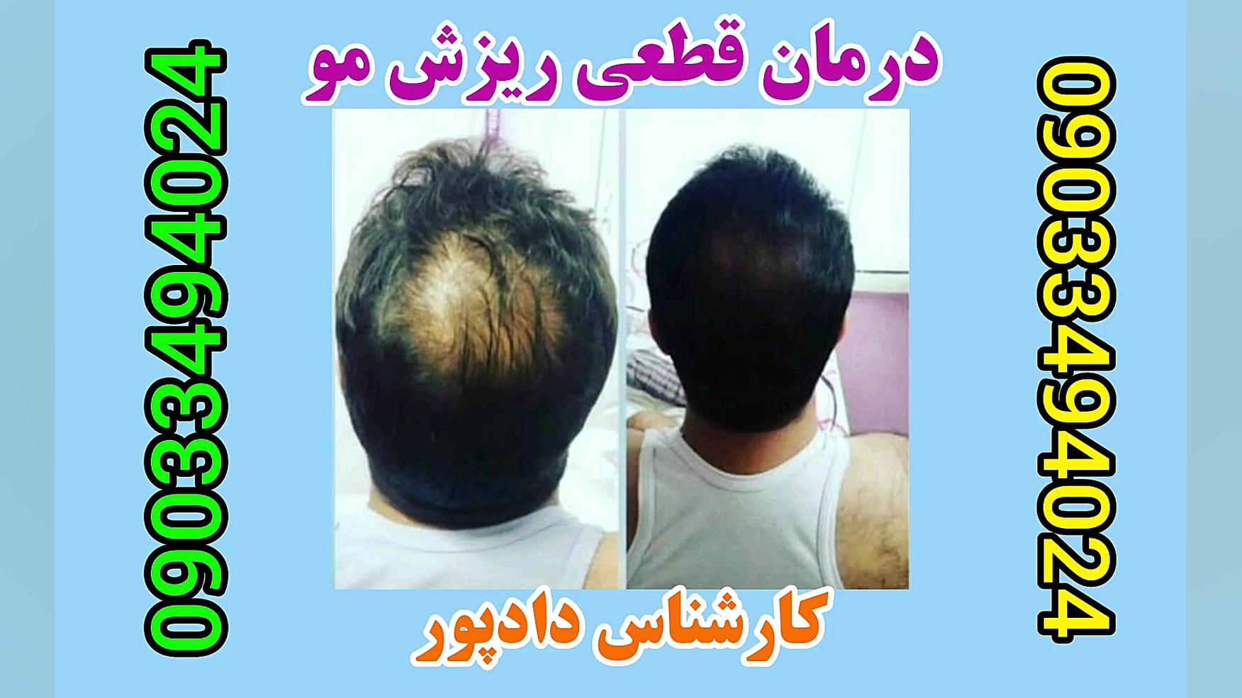 درمان ریزش مو هشتگ