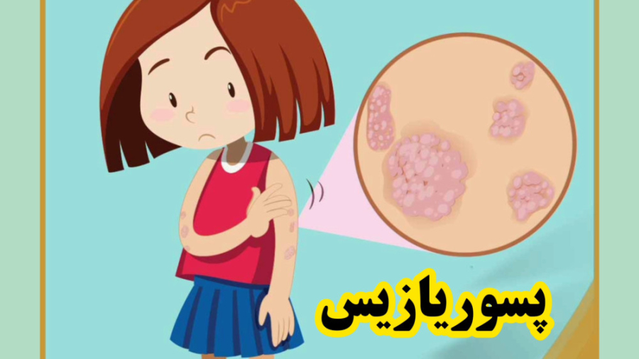 درمان پسوریازیس آهنگ بترکون