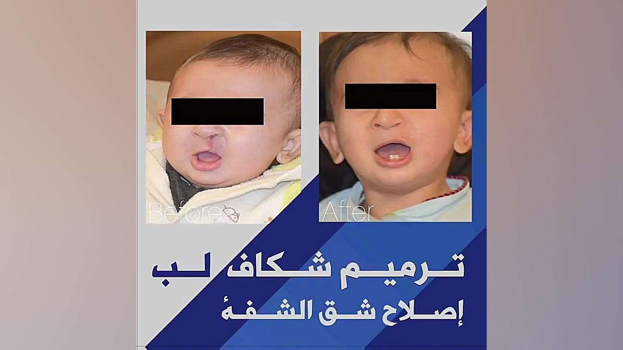 جراحی ترمیم شکاف کام لب دکتر حمید رضا فتحی فوق تخصص جراحی پلاستیک