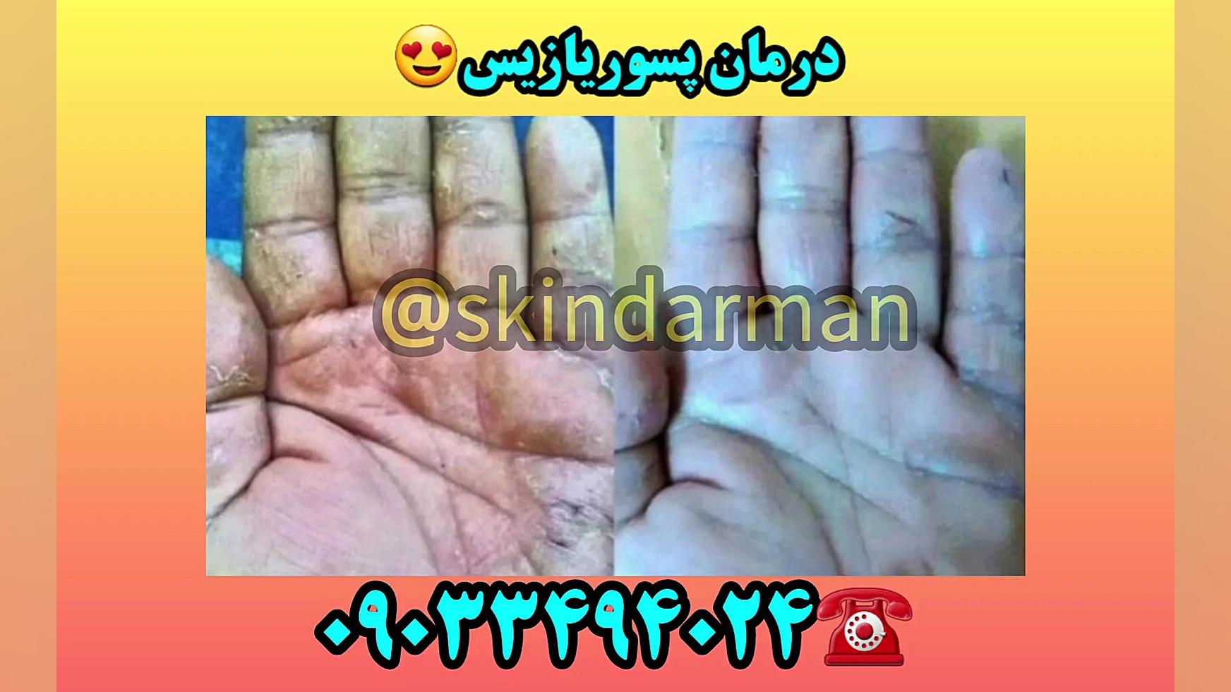 درمان پسوریازیس مزوتراپی