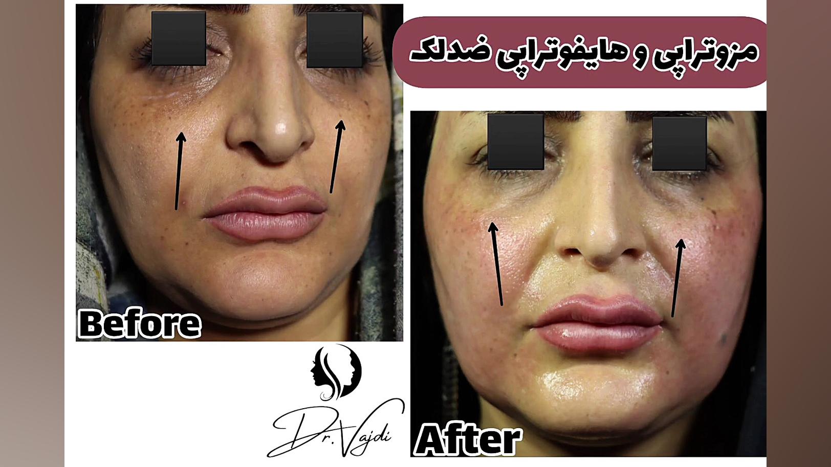 نتیجه یک جلسه مزوتراپی و هایفوتراپی ضد لک صورت دستگاه آنالیز ایمیجینگ سلول زنده