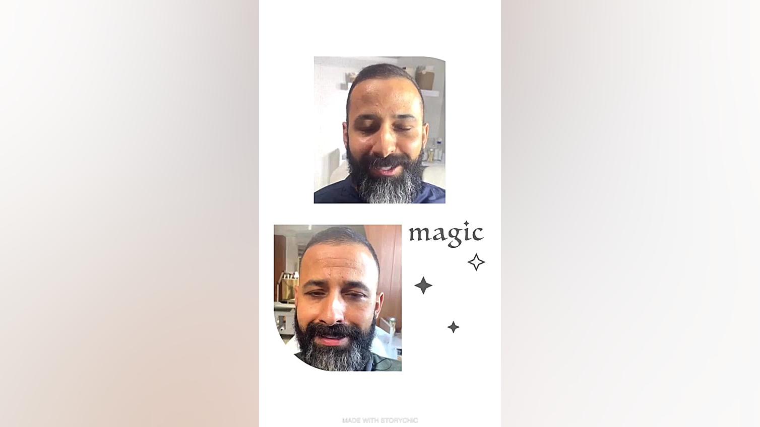 نحوه تزریق بوتاکس ۰۹۲۰۳۲۳۲۳۰۸ آزمایش ایمونوسورپشن