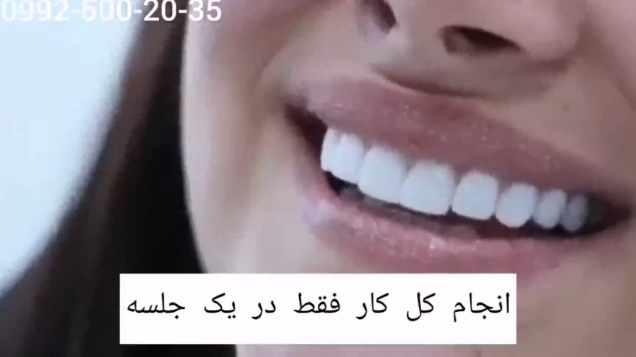 انجام کامپوزیت ونیر فقط از 199 هزار تومان HiChIP