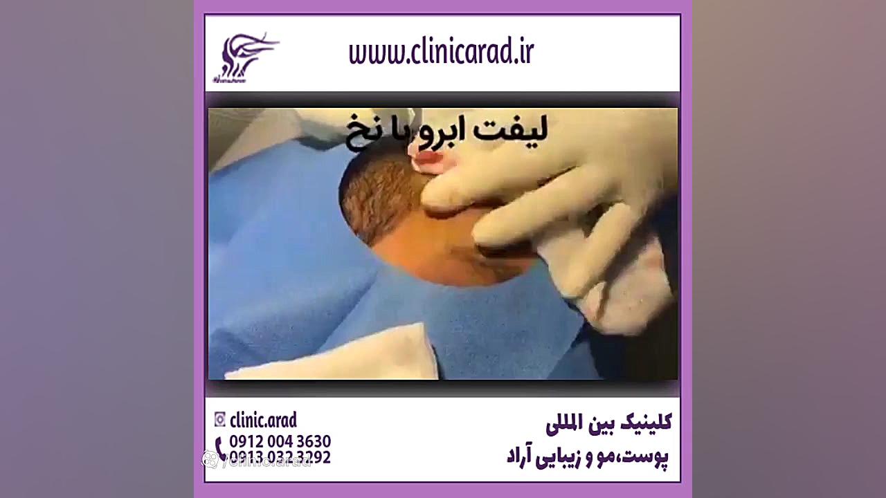 لیفت ابرو جراحی زیبایی پلک
