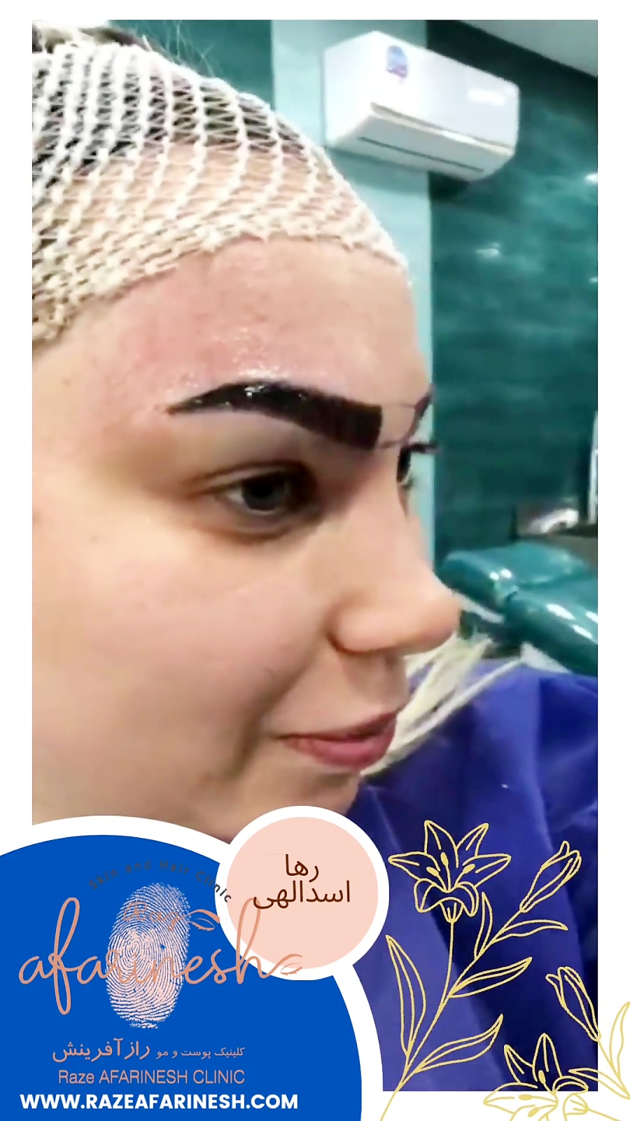 کاشت ابرو | رضایت زیبا جو | 09336566859|کلینیک بین المللی راز آفرینش