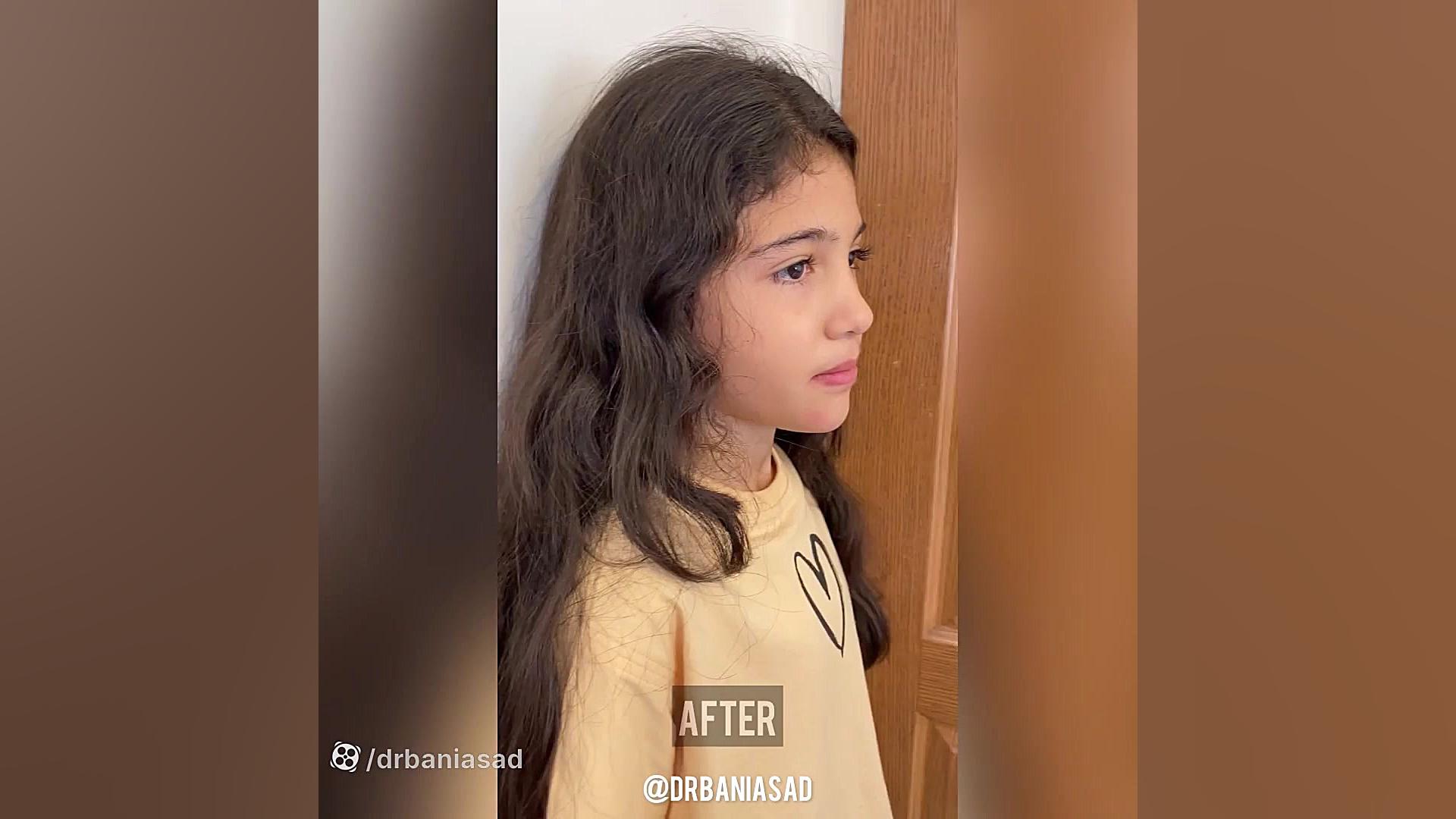 استفاده از دستگاه فیس ماسک برای درمان کودک با مشکل کلاس III - دکتر نیما بنی اسد دکتر نیما بنی اسد - متخصص ارتودنسی در تهران