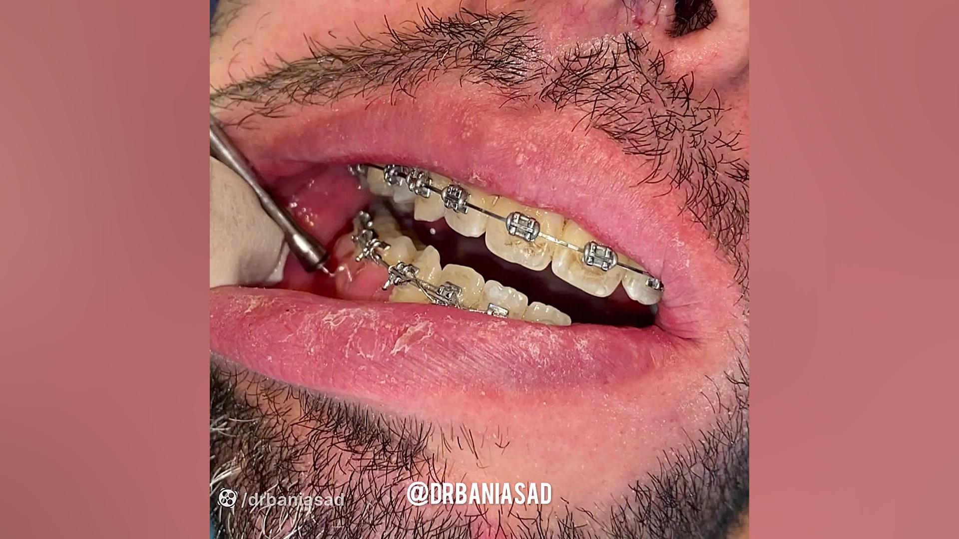 استفاده از مینی اسکرو در درمان ارتودنسی بیمار - دکتر نیما بنی اسد متخصص ارتودنسی دکتر نیما بنی اسد - متخصص ارتودنسی در تهران