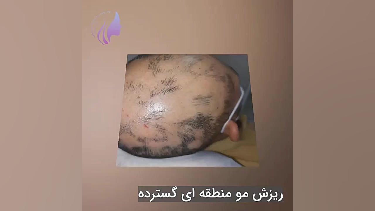 ریزش مو منطقه ای گسترده (الوپسیا اراتا) نتیجه درمان بعد از ۲ ماه دکتر صفیه چعباوی زاده
