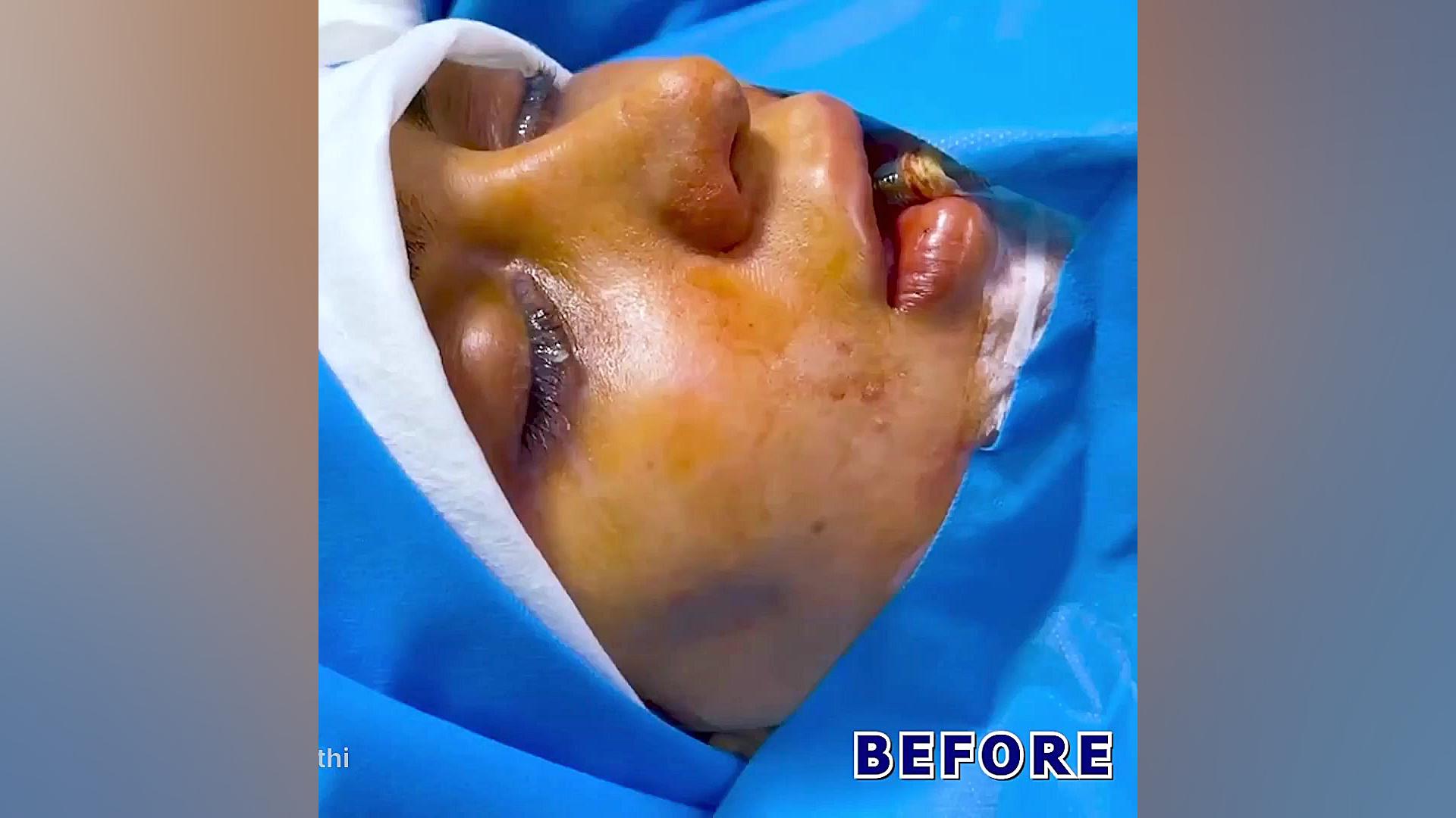 سپتورینوپلاستی چیست؟ بعلاوه فیلم واقعی جراحی بینی دکتر حمید رضا فتحی فوق تخصص جراحی پلاستیک
