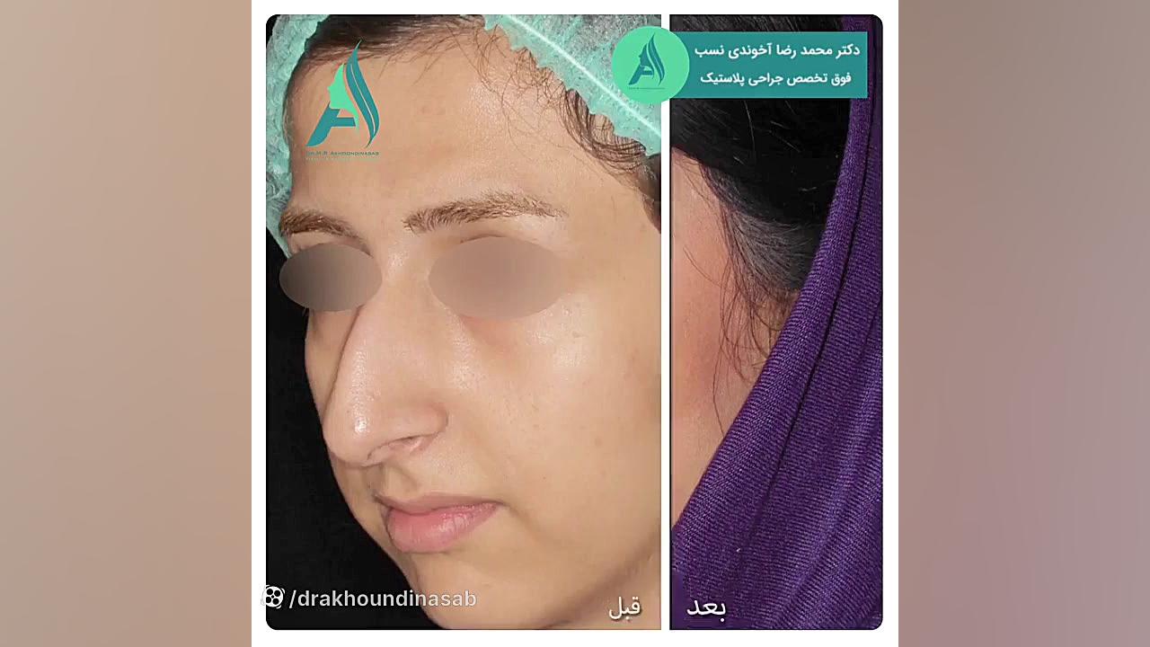 اصلاح انحراف بینی دکتر محمدرضا آخوندی نسب-فوق تخصص جراحی پلاستیک
