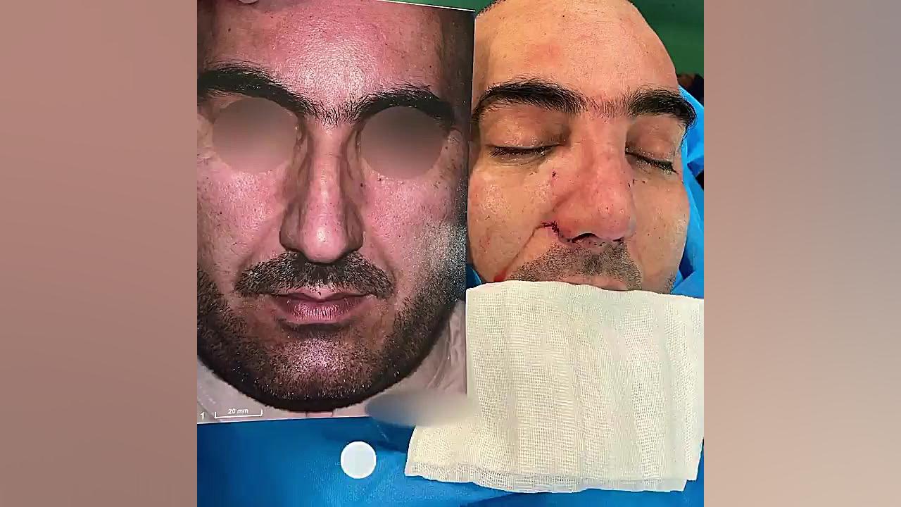 فیلم واقعی جراحی سپتورینوپلاستی دکتر حمید رضا فتحی فوق تخصص جراحی پلاستیک