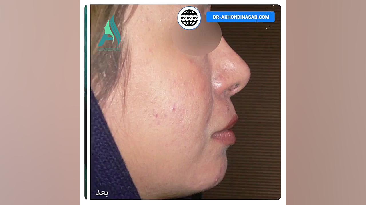 جراحی همزمان بینی گوشتی و پروتز چانه دکتر محمدرضا آخوندی نسب-فوق تخصص جراحی پلاستیک