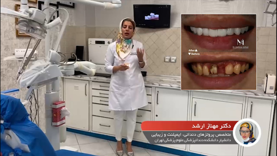 بازسازی لبخند توسط روکش های دندانی دکتر مهناز ارشد