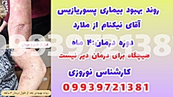 وزمان خانگی پسوریازیس