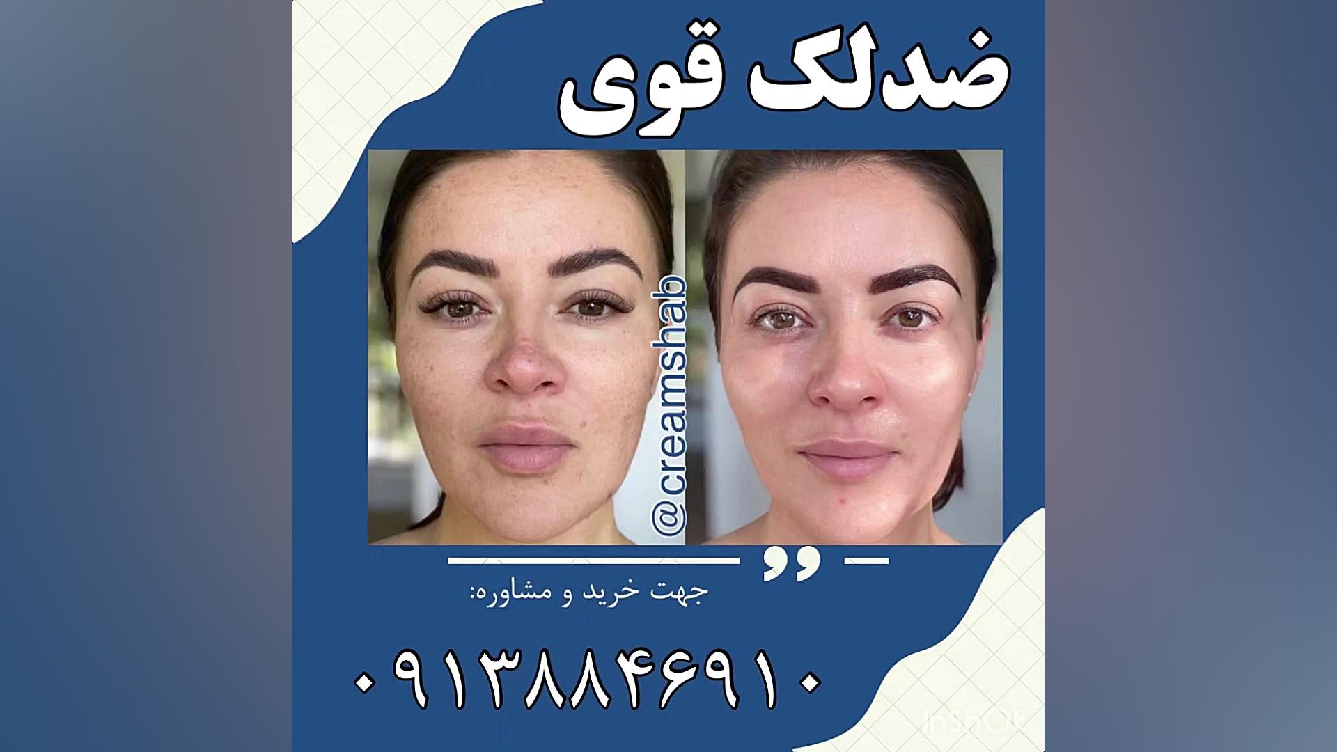 کرم ضدلک معجزه لیزر صورت