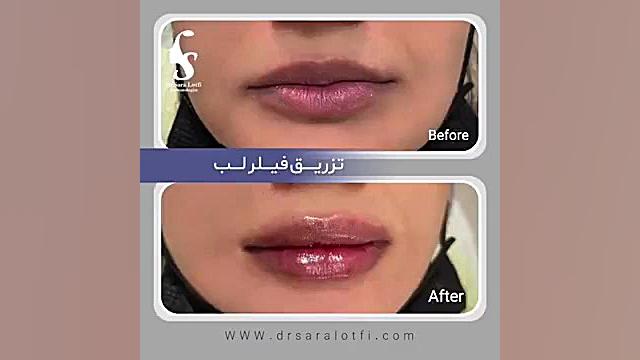تزریق فیلر لب دکتر سار ا لطفی
