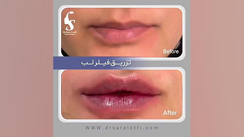 تزریق فیلر لب دکتر سار ا لطفی