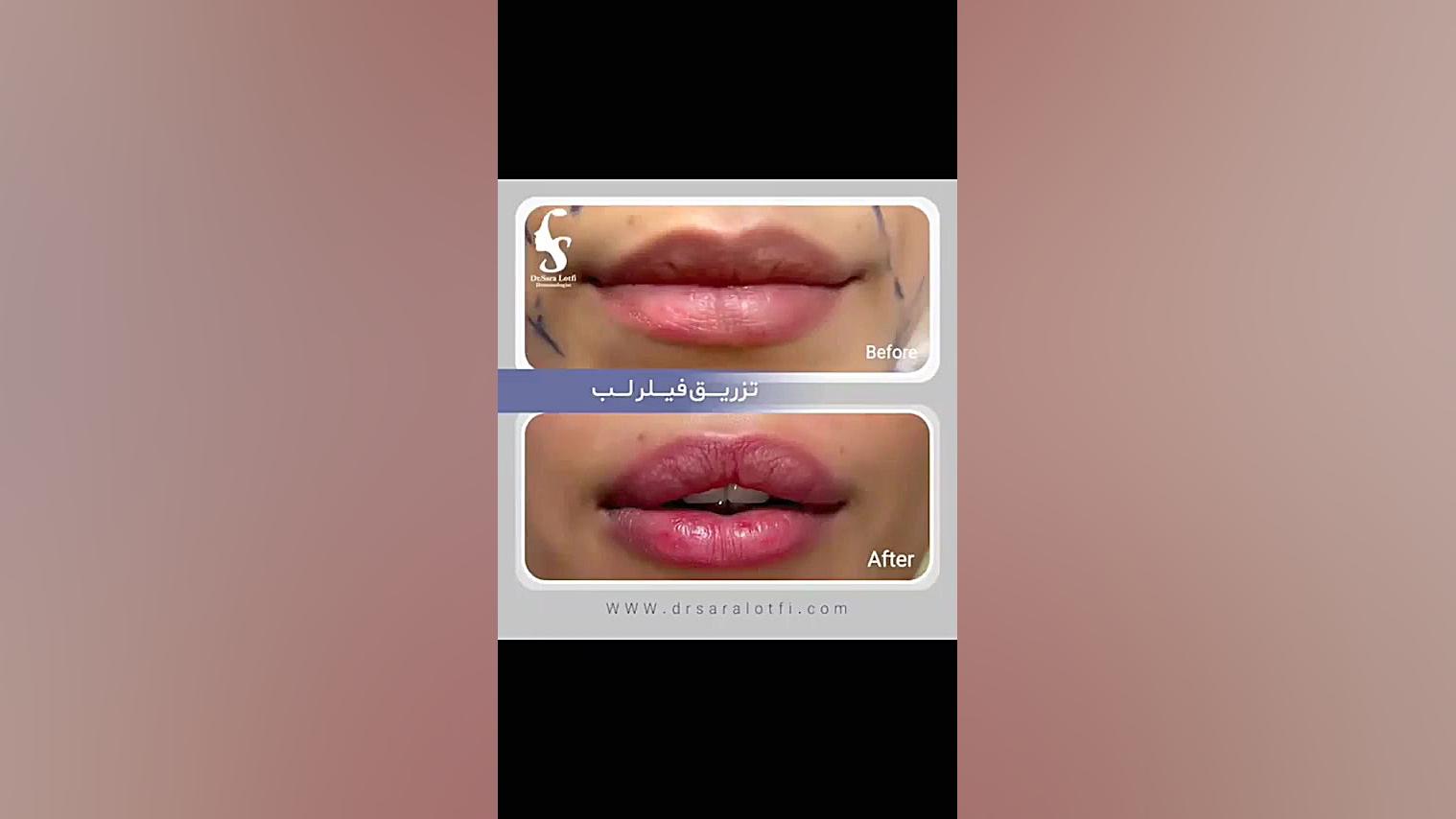 تزریق فیلر لب دکتر سار ا لطفی