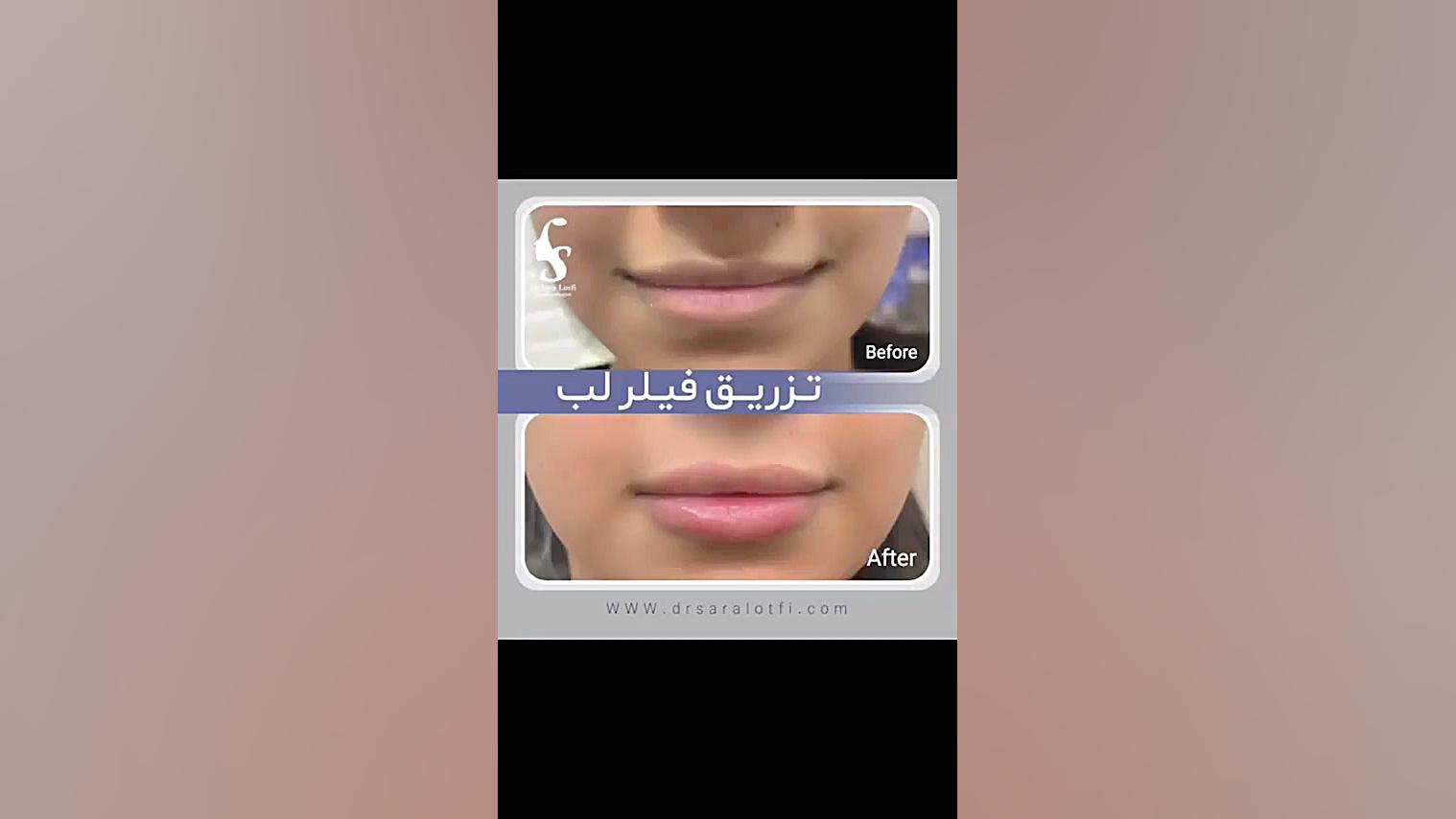 تزریق فیلر لب دکتر سار ا لطفی