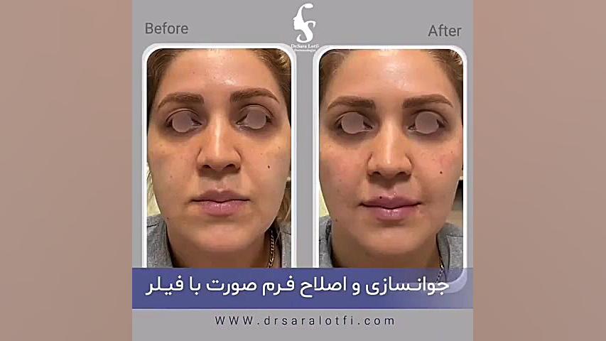 جوانسازی و اصلاح فرم صورت با #تزریق_فیلر دکتر سار ا لطفی