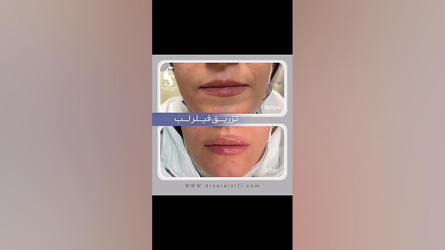 تزریق فیلر لب دکتر سار ا لطفی
