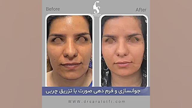 جوانسازی و فرمدهی صورت با تزریق چربی دکتر سار ا لطفی