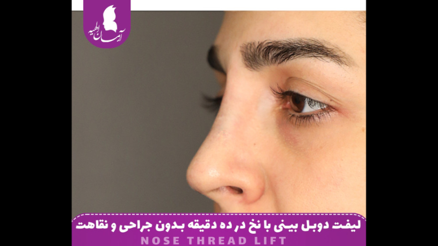 لیفت دوبل بینی با نخ در ده دقیقه بدون جراحی رفع چین و چروک
