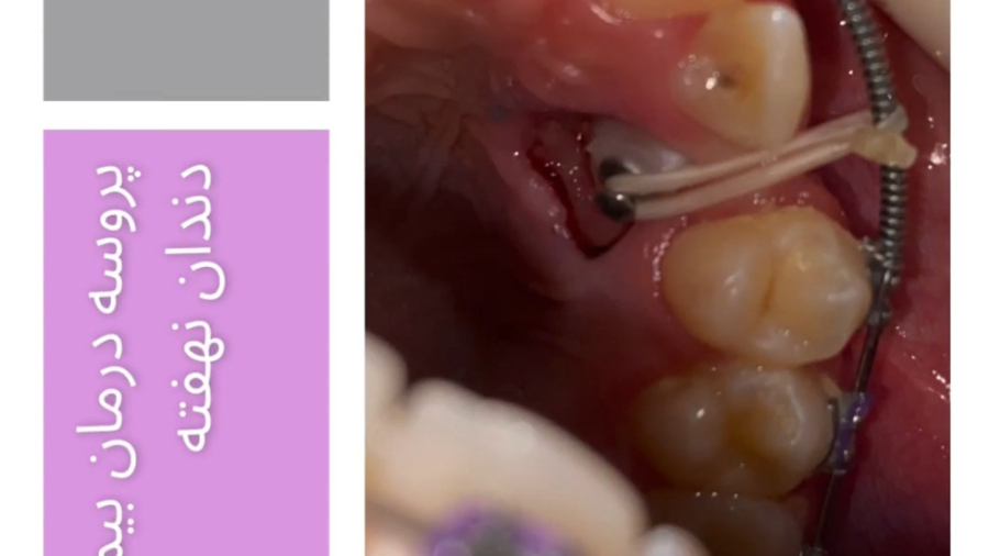 درمان ارتودنسی بیمار با دندان نهفته - دکتر نیما بنی اسد متخصص ارتودنسی دکتر نیما بنی اسد - متخصص ارتودنسی در تهران
