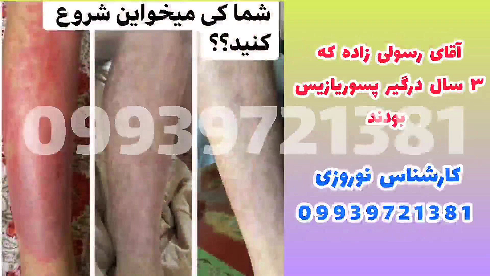 درمان خانگی پسوریازیس لاکپشت رقصان