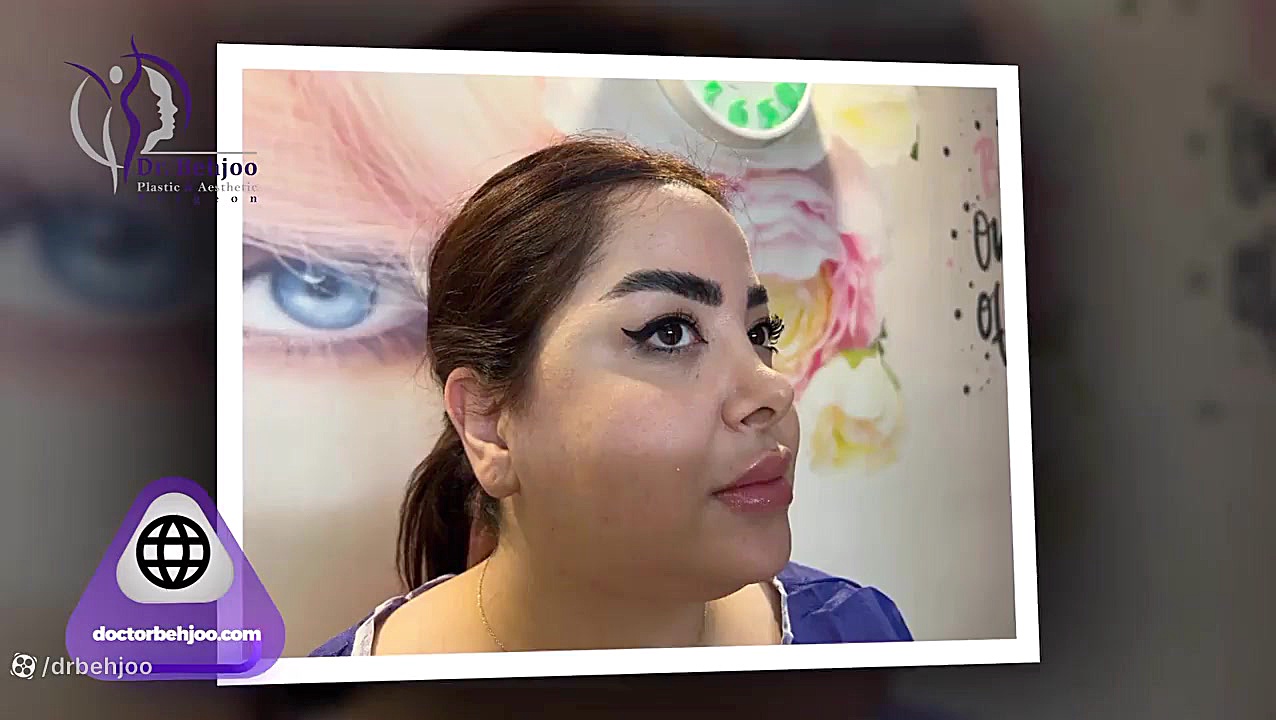 ۱۰ روز بعد از لیپو غبغب و بوکال فت دکتر شاهین بهجو - فوق تخصص جراحی پلاستیک