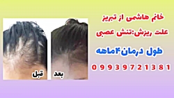 درمان خانگی ریزش مو
