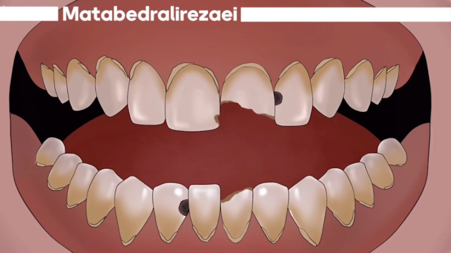 مراحل انجام شدن کامپوزیت مطب دکتر علیرضایی