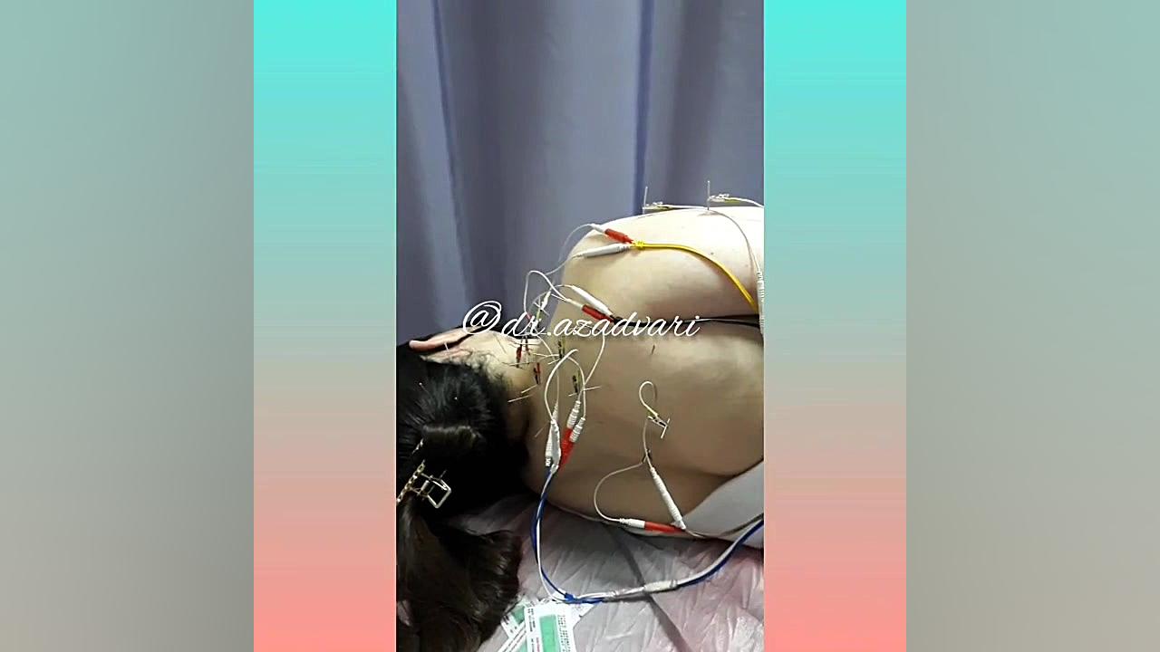 کاربرد طب سوزنی در دردهای ناحیه گردن و شانه دکتر محدثه آزادواری