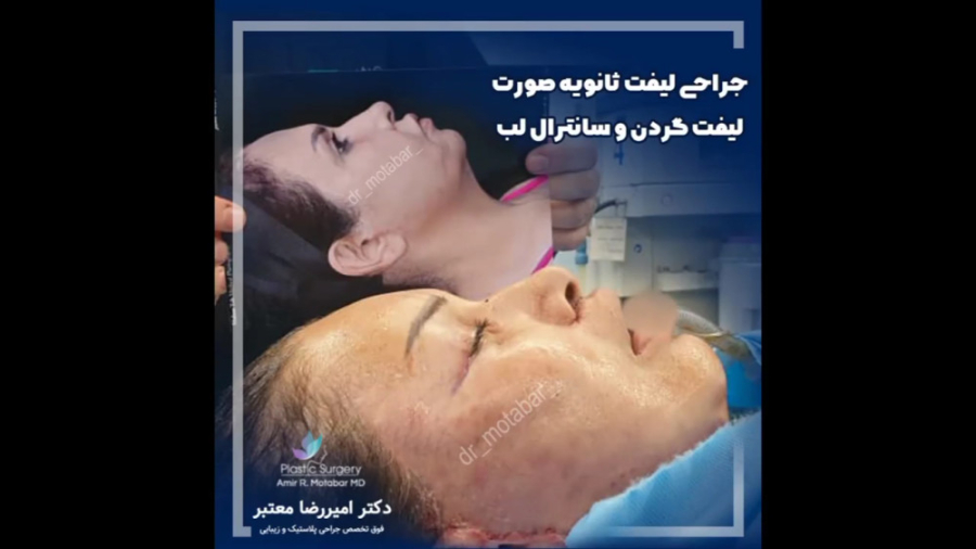 جراحی لیفت صورت و گردن تریلر تصویربرداری بالینی
