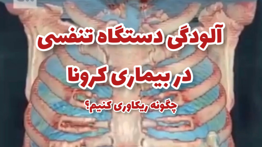 آلودگی دستگاه تنفسی در بیماری کرونا ( چگونه ریکاوری کنیم؟) جراحی پف زیر چشم