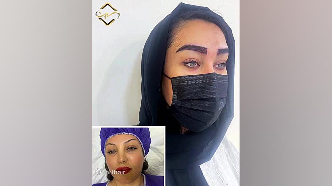 کاشت ابرو لیزری ایلوبامید