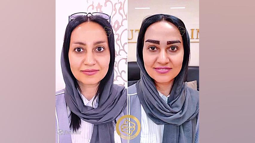 تکنیک جدید کاشت ابرو کلینیک سینا In Situ Hybridization