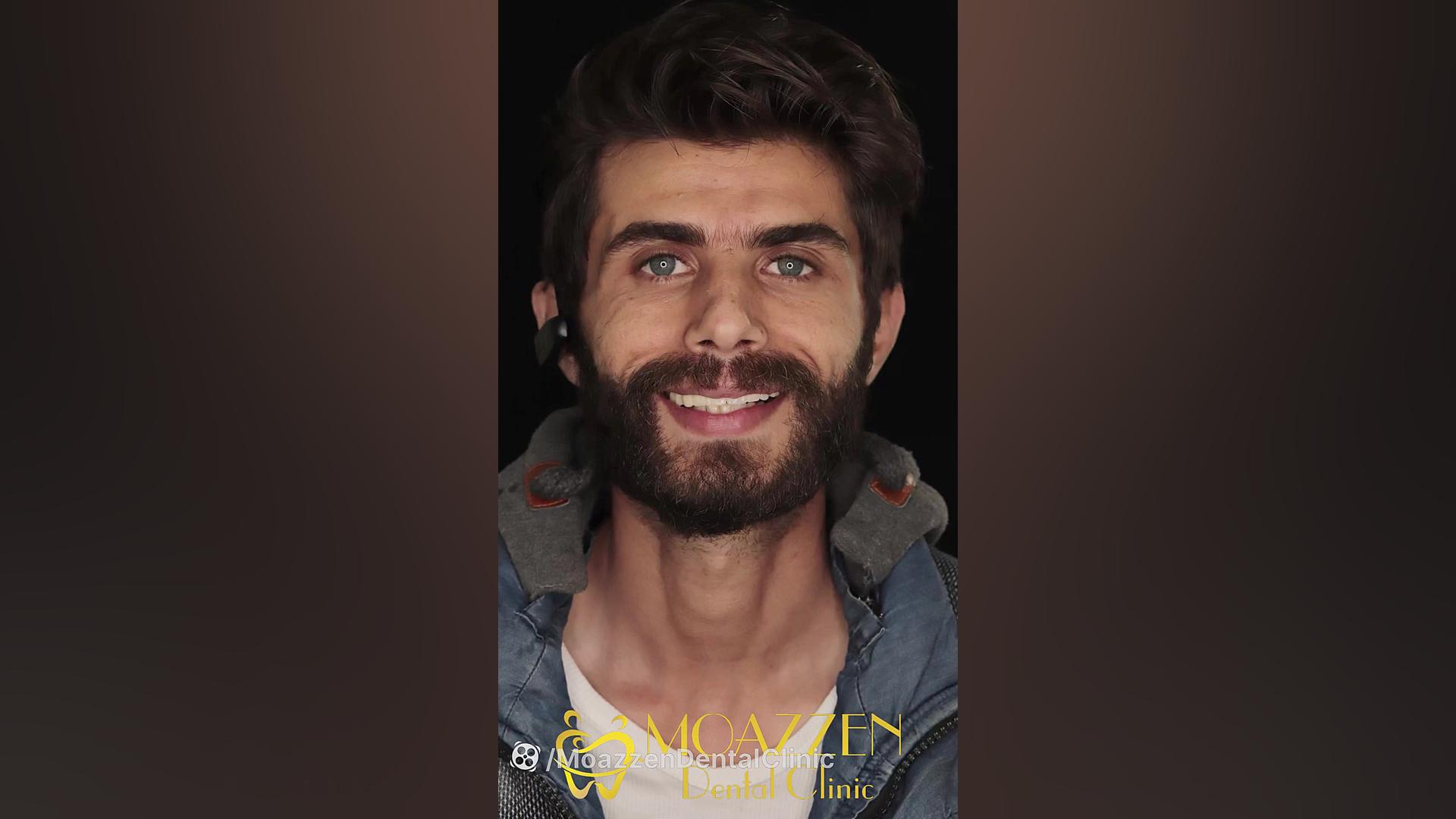 ایمپلنت فول فک بالا کلینیک دندانپزشکی موذن