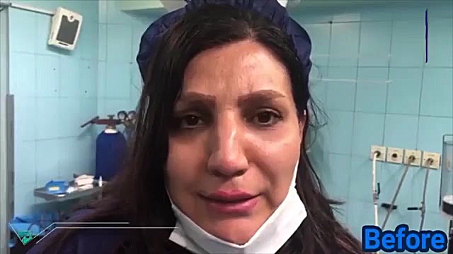 قبل و بعد از جراحی بینی (فیلم اتاق عمل) کلینیک دندانپزشکی