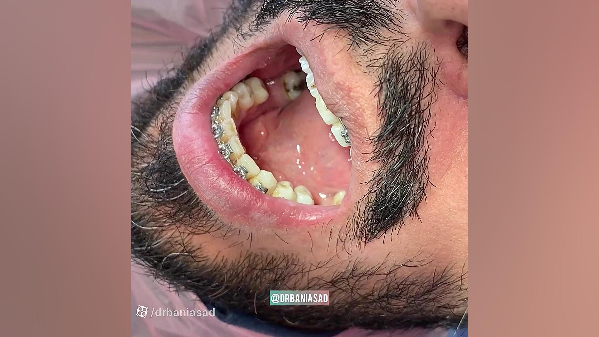 پروسه درمان بیمار با استفاده از مینی اسکرو - دکتر نیما بنی اسد متخصص ارتودنسی دکتر نیما بنی اسد - متخصص ارتودنسی در تهران