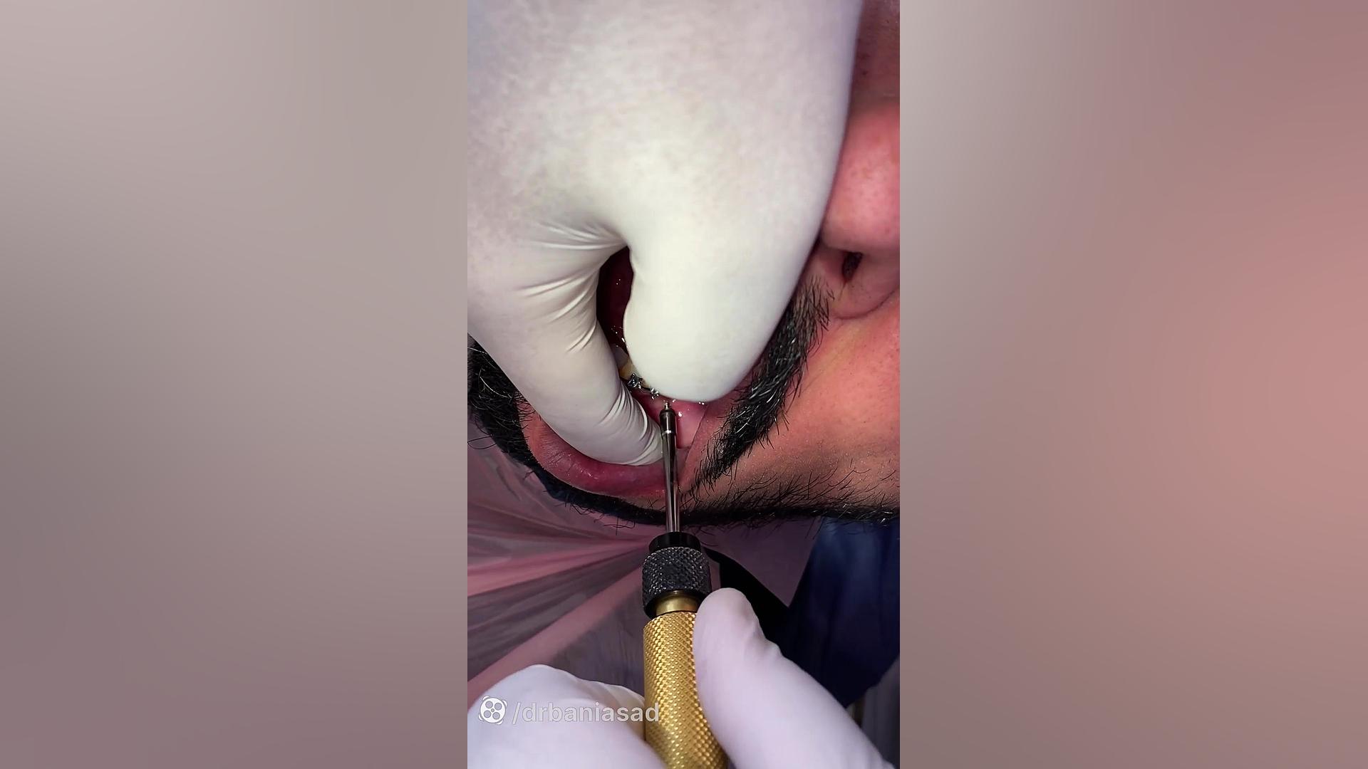 پروسه درمان بیمار با استفاده از مینی اسکرو - دکتر نیما بنی اسد متخصص ارتودنسی دکتر نیما بنی اسد - متخصص ارتودنسی در تهران