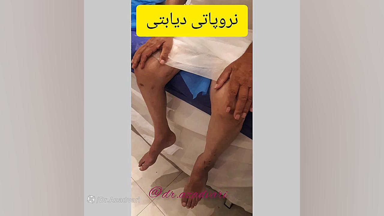 نروپاتی دیابتی دکتر محدثه آزادواری