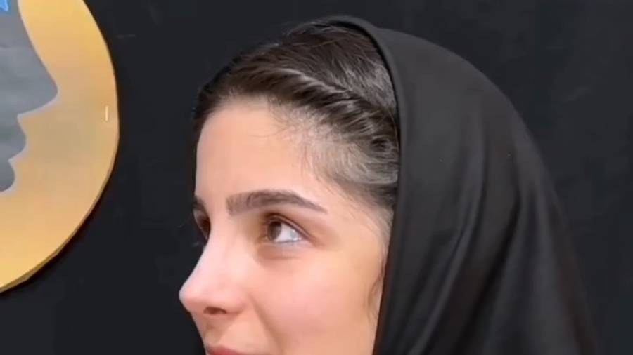 نمونه کار جراحی بینی بعد از 4 ماه | دکتر محمدعلی حسینی سیتوژنتیک مولکولی