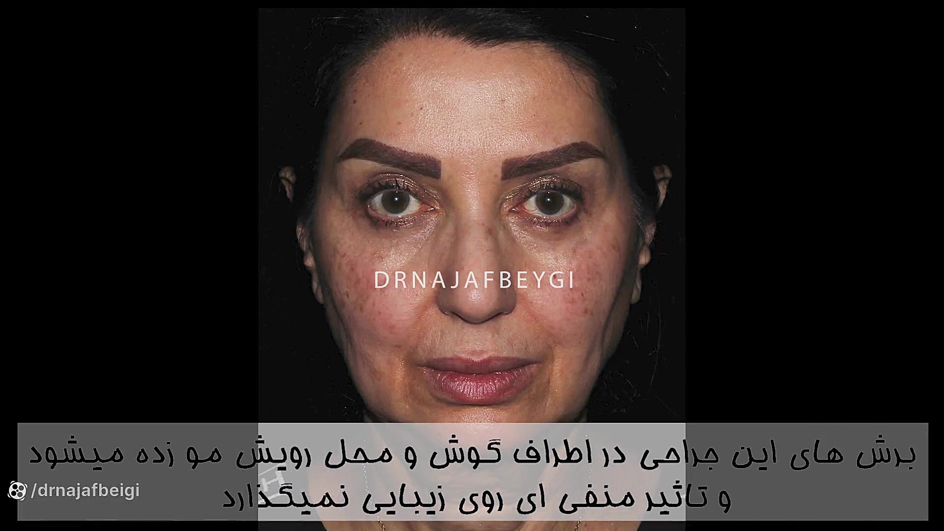 جراحی لیفت صورت دستگاه لیزر پالس فمتوثانیه