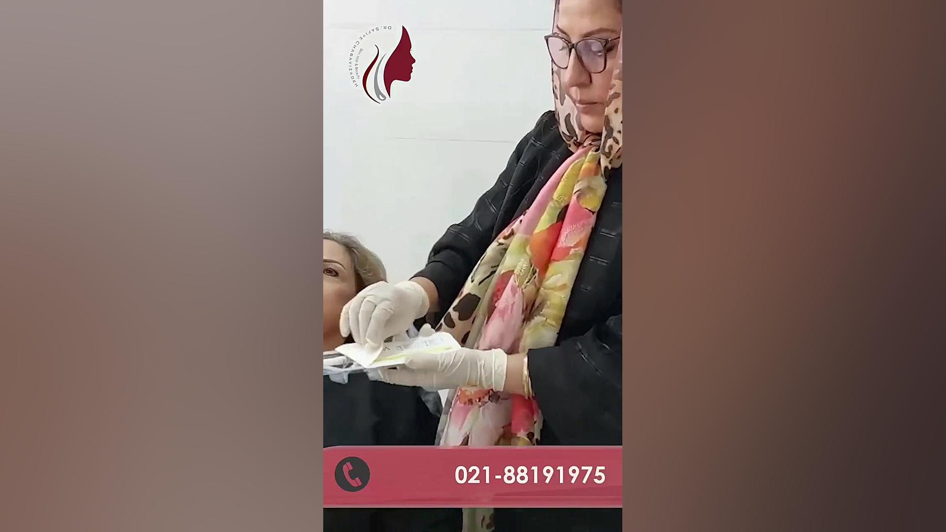 کاهش چین نازولابیا با تزریق ۱ سی سی ژل دکتر صفیه چعباوی زاده