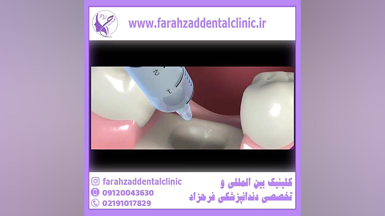 تزریق استخوان به لثه ها برای ایمپلنت لیپوماتیک