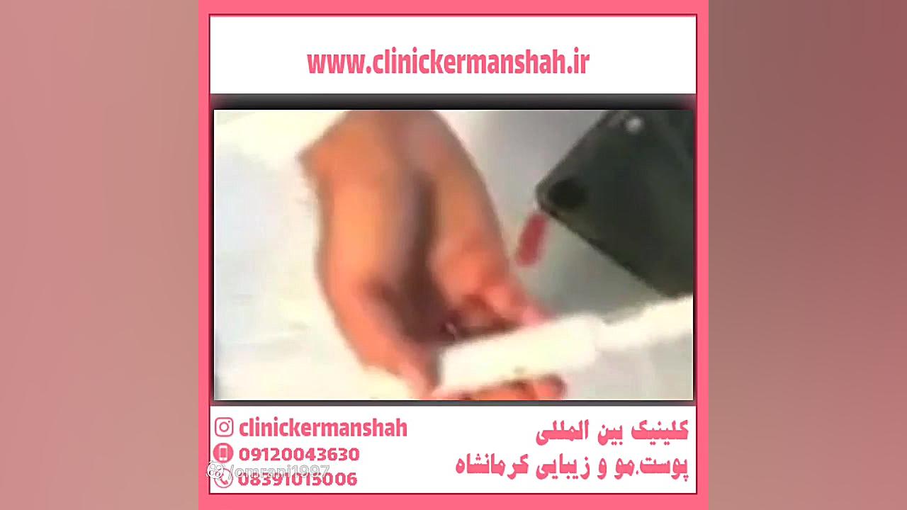 تزریق ژل و چربی به آلت تناسلی پالپوتومی