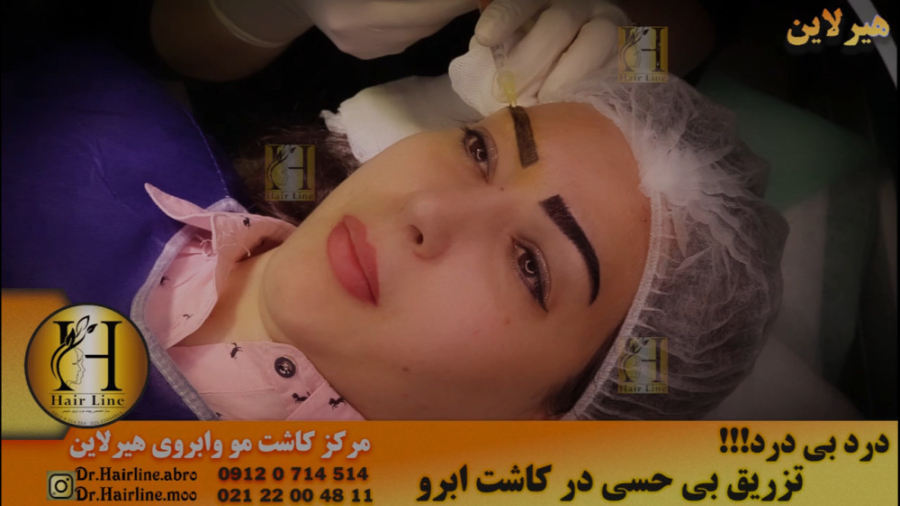 تزریق بی حسی کاشت ابرو در مرکز هیرلاین PEFR