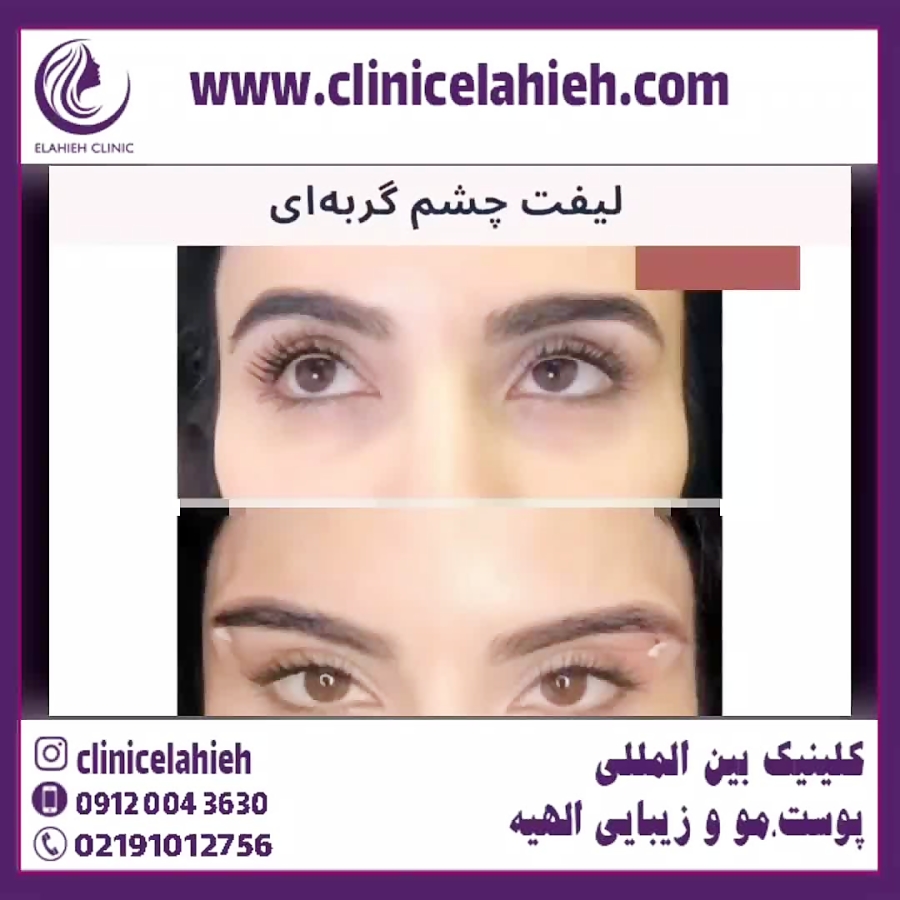 لیفت چشم گربه ای